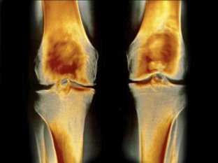 artroza koljena uzrokuje i liječenje)