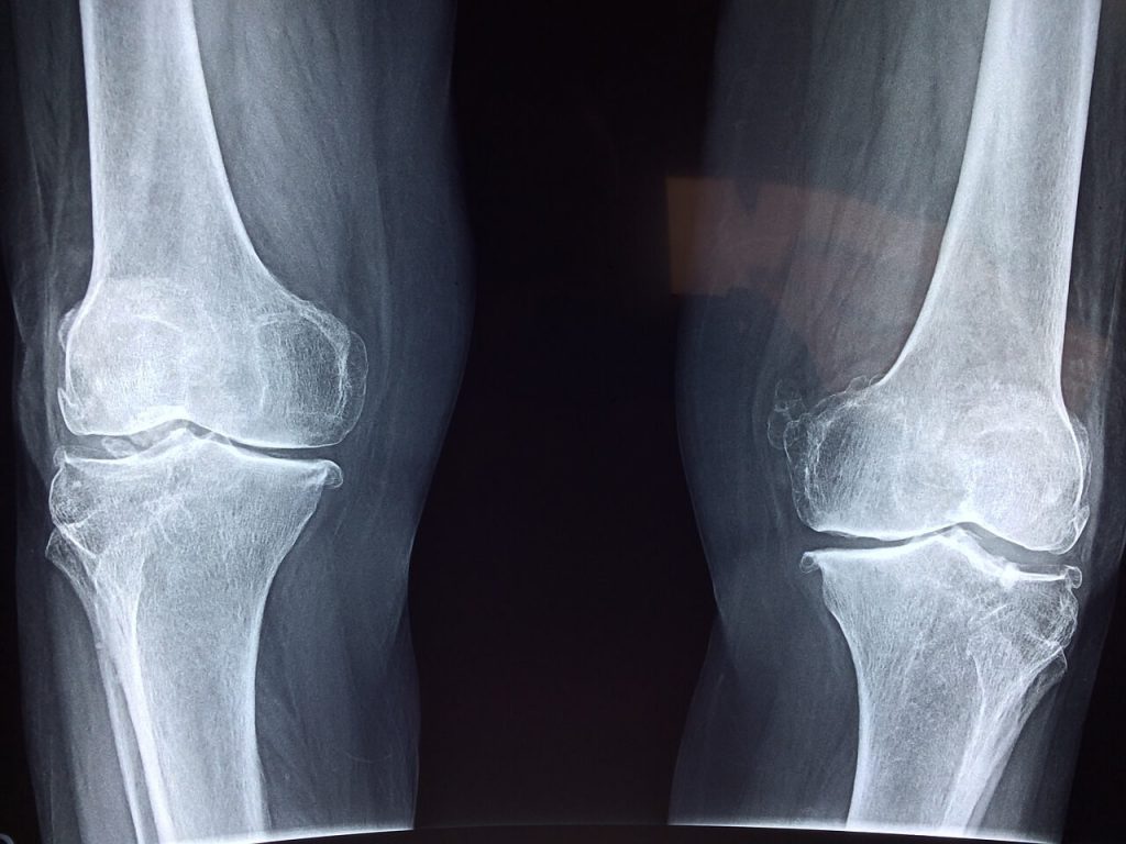 artroza kolana leczenie examenul lichidului sinovial
